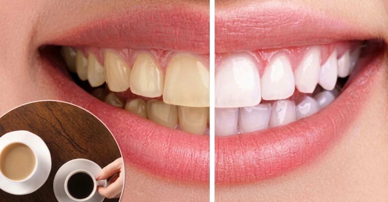 Does Coffee Stain Veneers or Crowns1